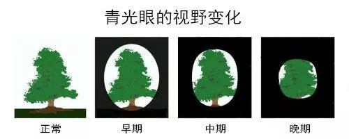 青光片1.jpg 青光片1.jpg